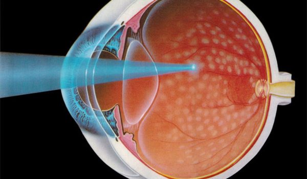 LASER-RETINOPATIA-DIABETICA